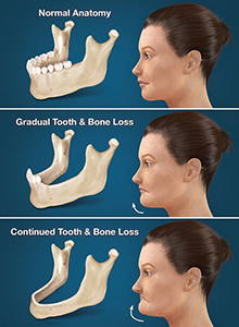 Full Arch Dental Implants Parma Heights