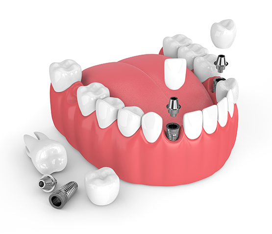 Dental Implants Parma Heights
