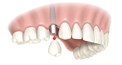 Single Dental Implants Parma Heights